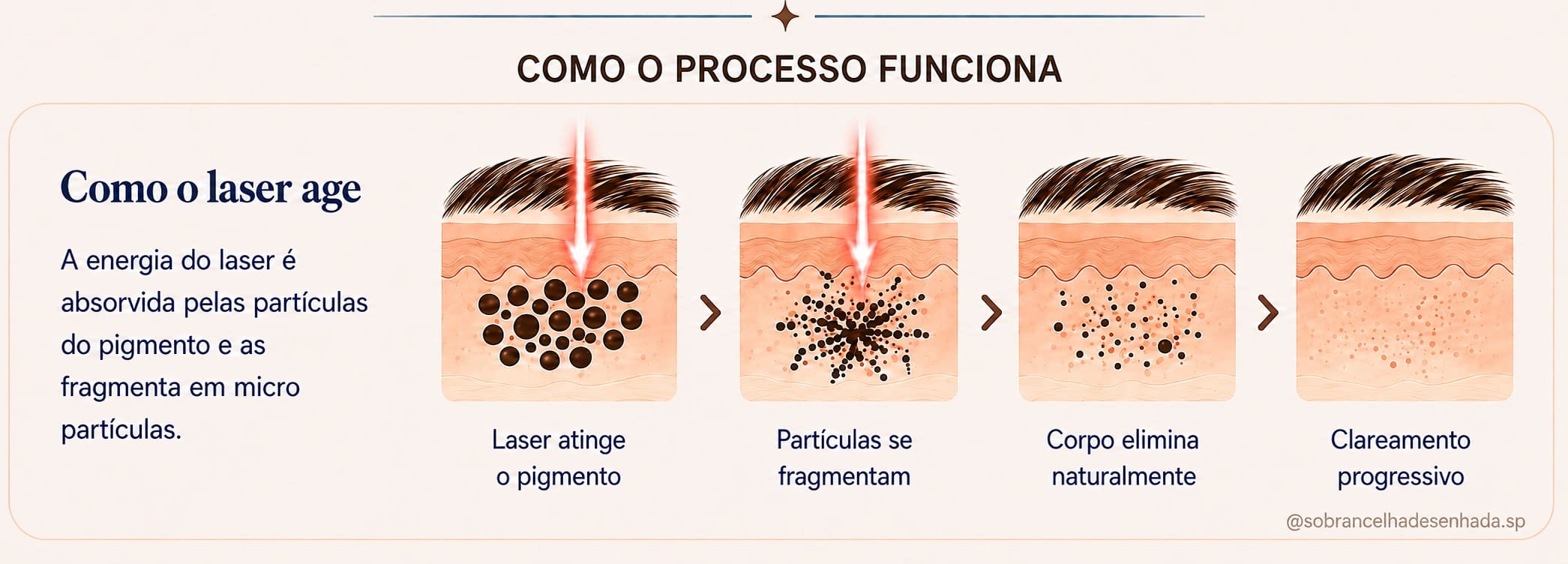 Como o laser fragmenta o pigmento para o corpo eliminar naturalmente até o clareamento progressivo